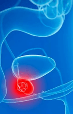 Prostatite