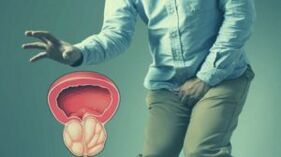 Prostatite aguda